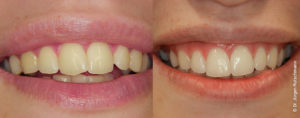 Invisalign Zahnarzt Grenzach, Lörrach, Rheinfelden