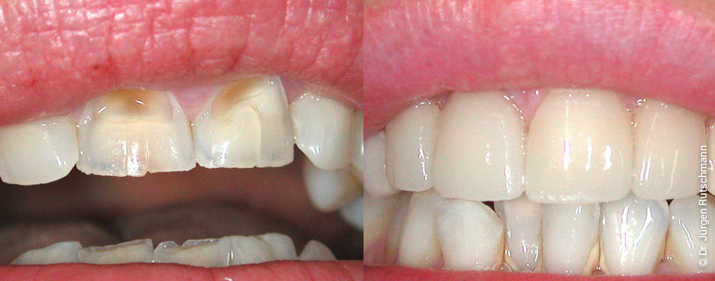 Veneers Grenzach