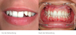 Veneers Basel