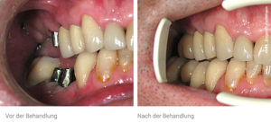 Zahnarzt Implantate Basel